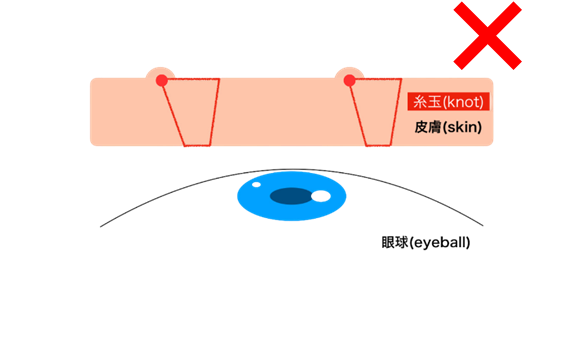 術前