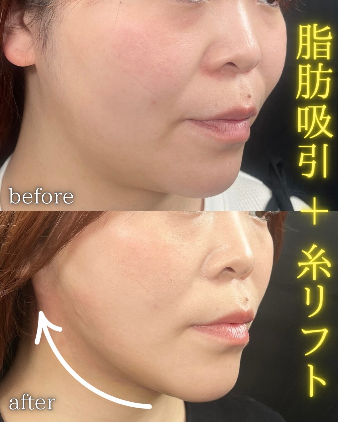 小顔脂肪吸引ロイヤル 症例(木暮 啓一郎)