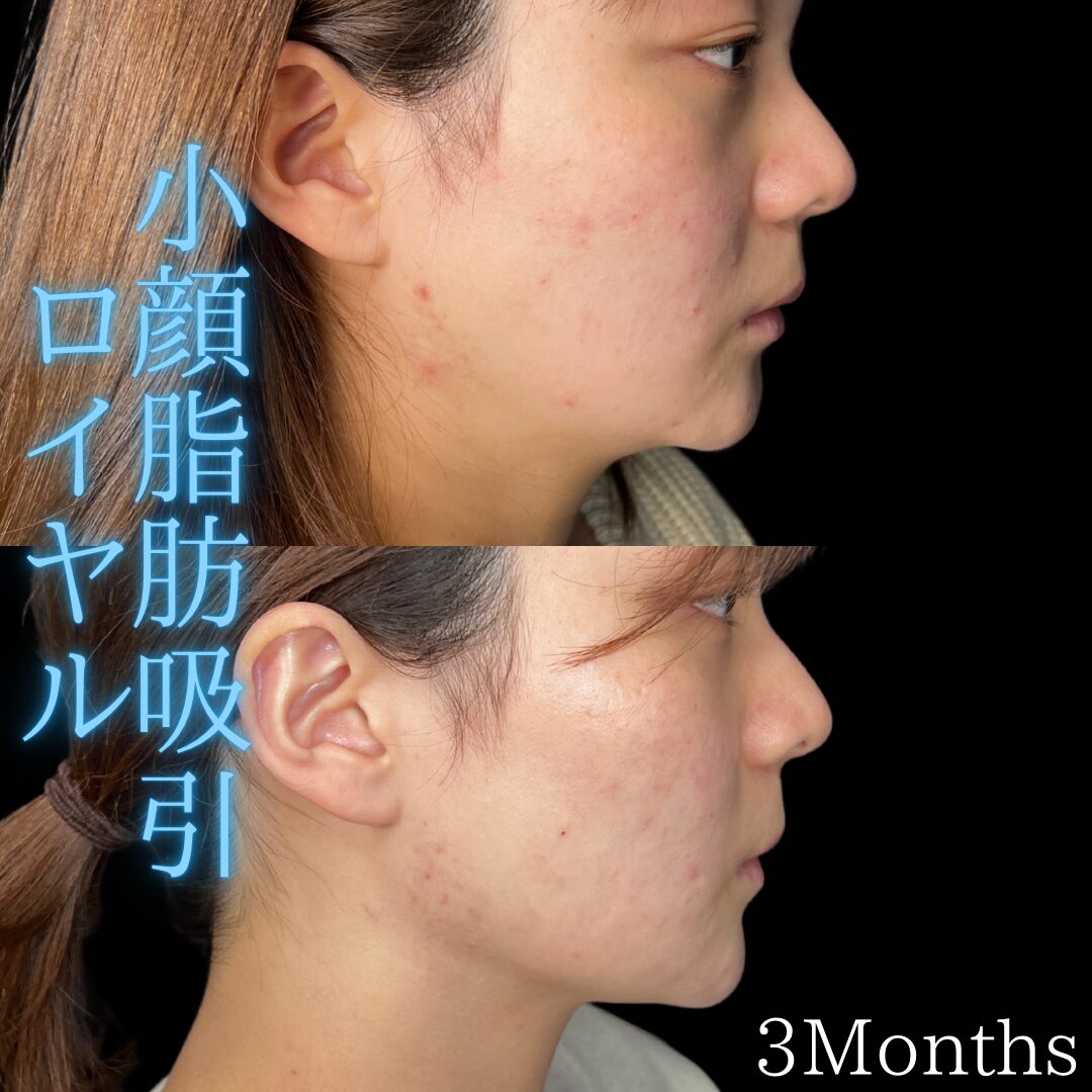 小顔脂肪吸引ロイヤル 症例（惟村 公郁）