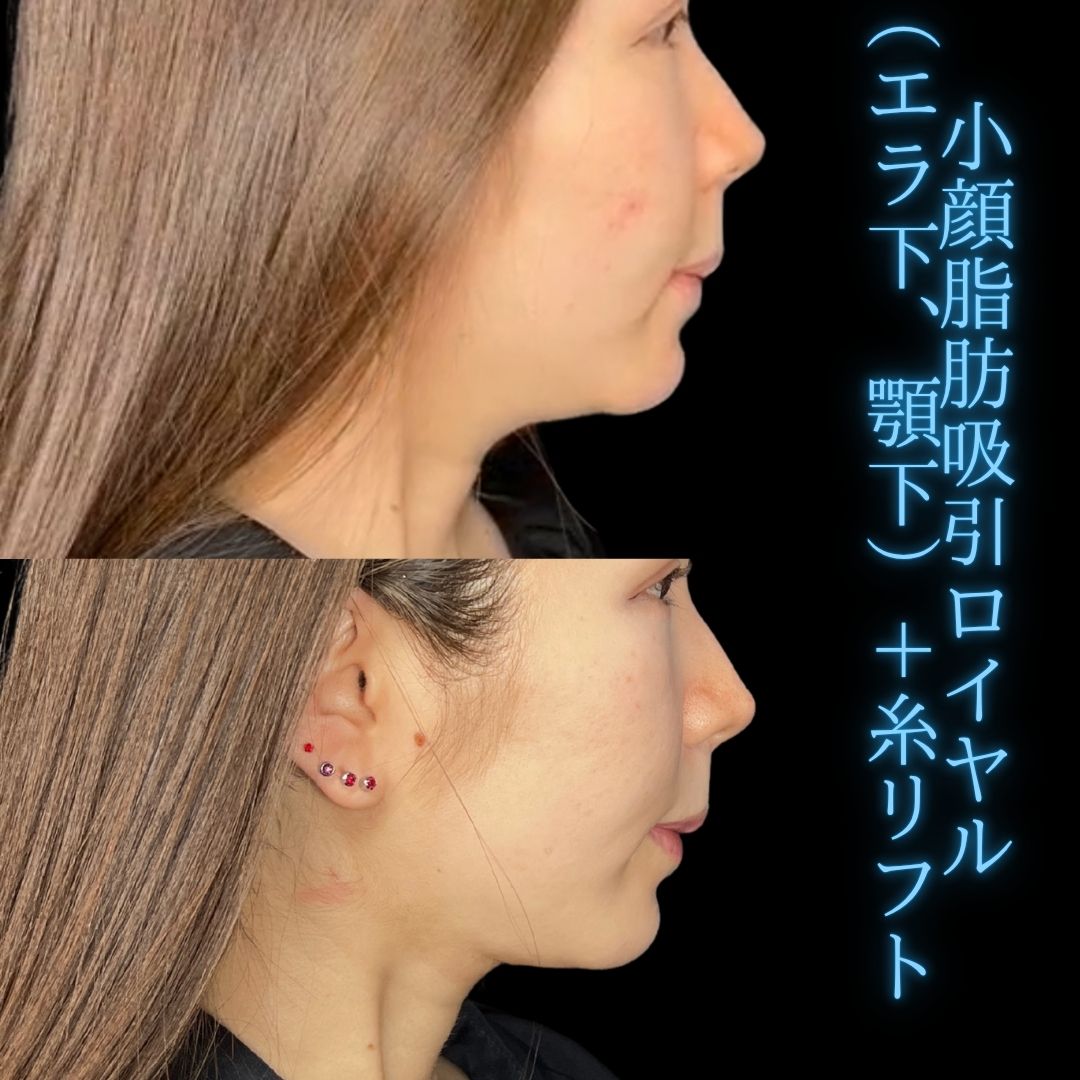 症例写真：小顔脂肪吸引＋糸リフト（術前・術後）