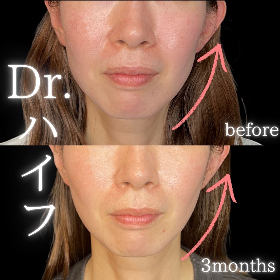 症例写真：ハイフ（術前・術後）