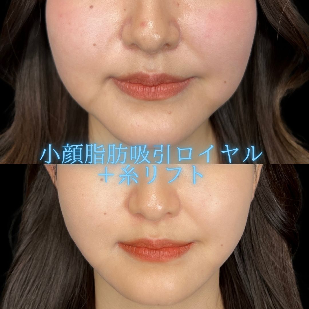症例写真：小顔脂肪吸引＋糸リフト（術前・術後）