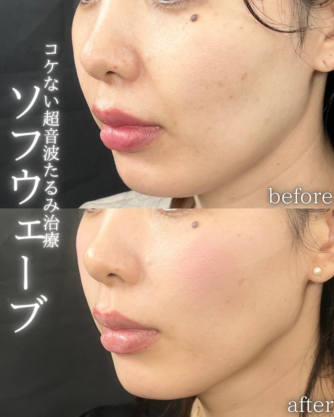 症例写真：ソフウェーブ（術前・術後）