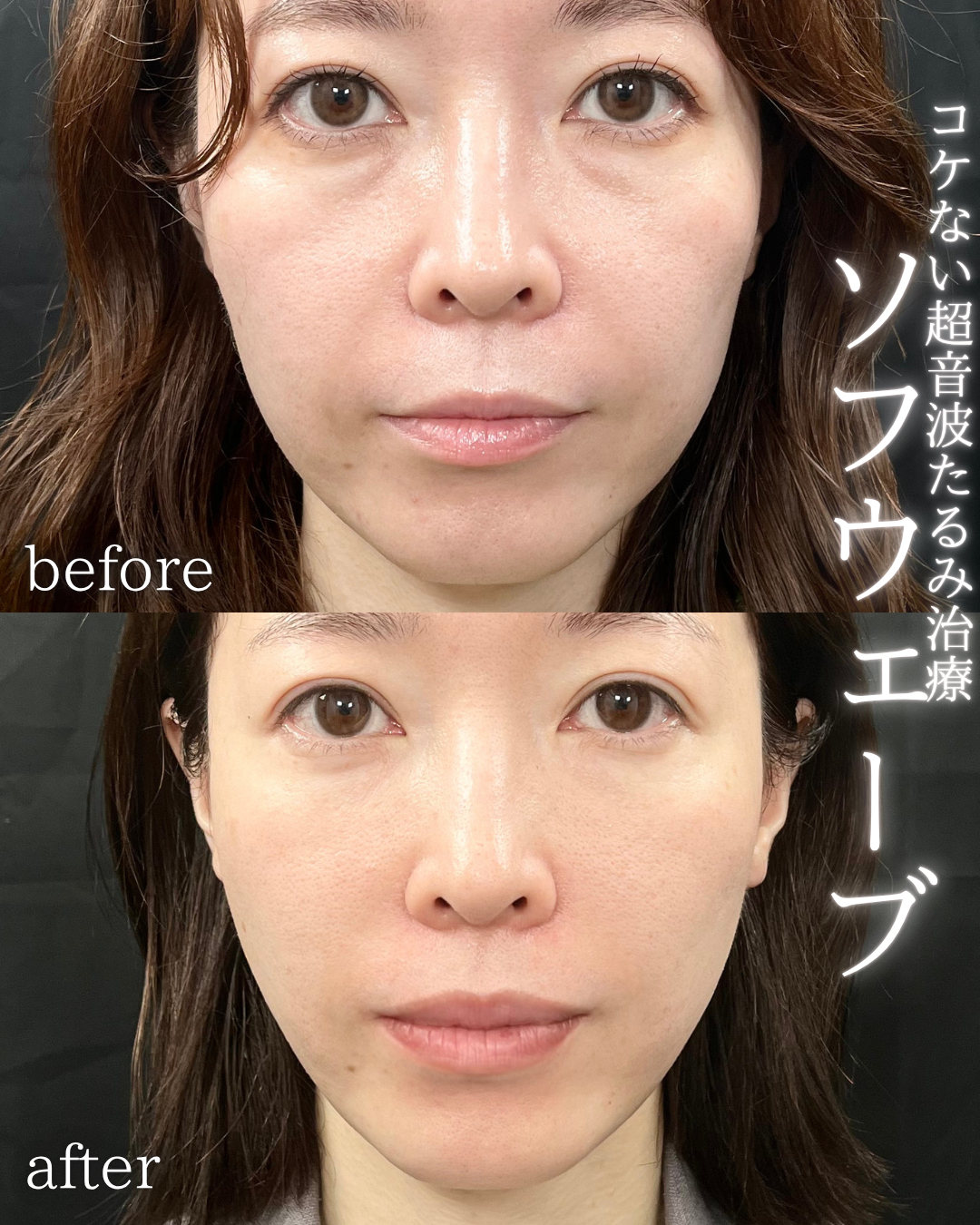 症例写真：ソフウェーブ（術前・術後）