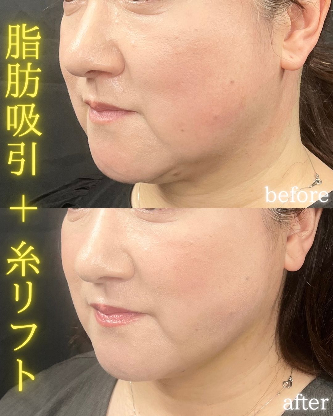 症例写真：小顔脂肪吸引＋糸リフト（術前・術後）