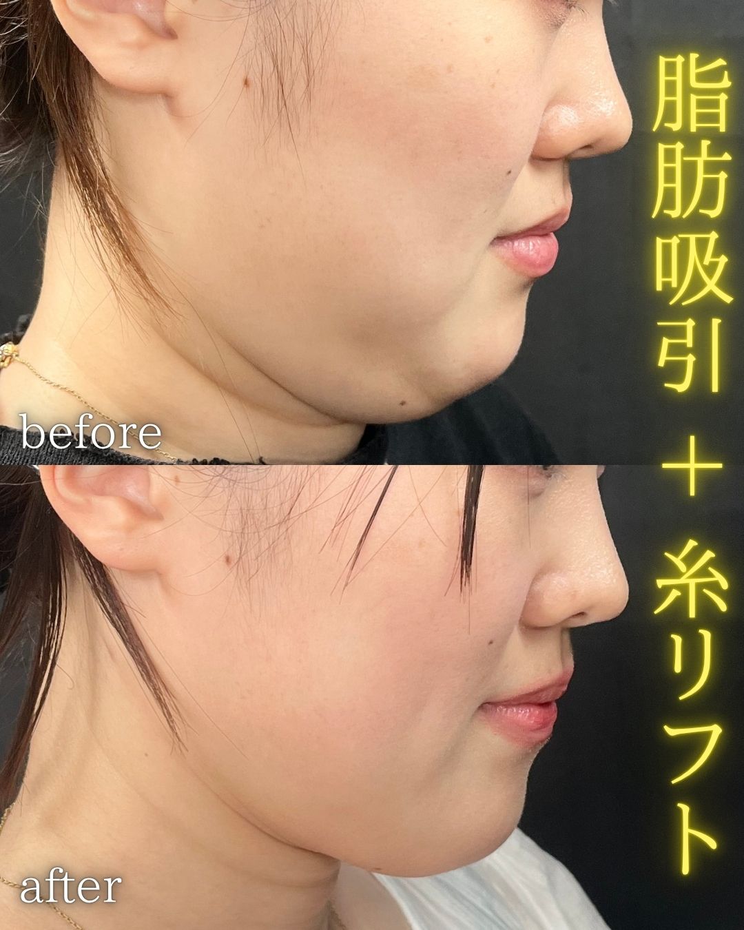 症例写真：小顔脂肪吸引＋糸リフト（術前・術後）