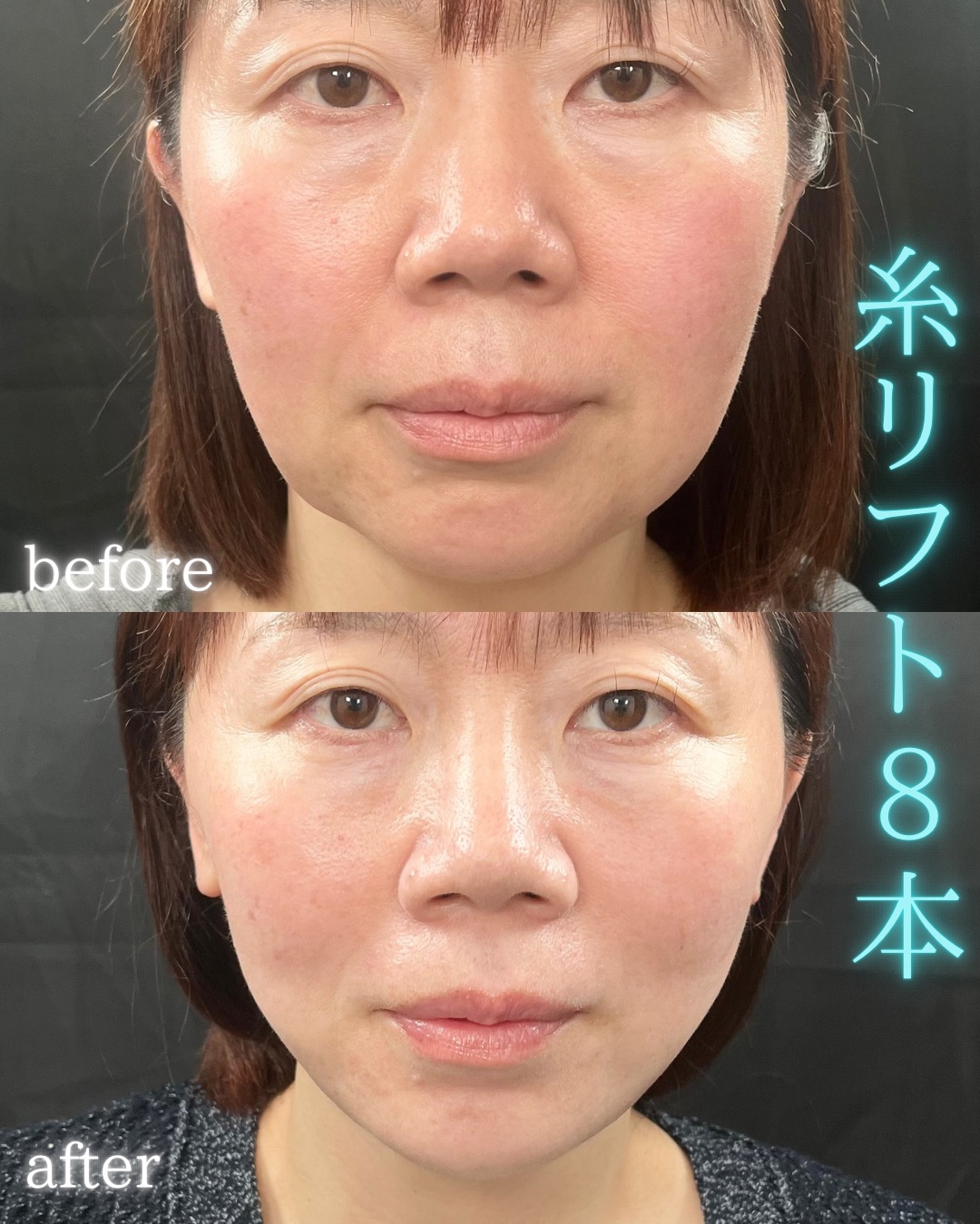 症例写真：糸リフト（術前・術後）