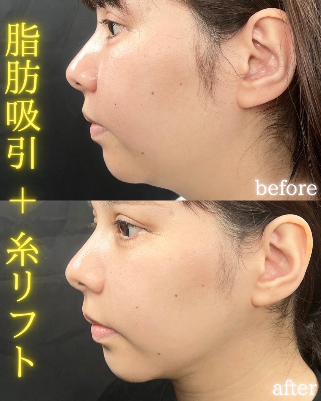 症例写真：小顔脂肪吸引＋糸リフト（術前・術後）