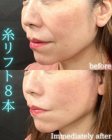 症例写真：糸リフト（術前・術後）