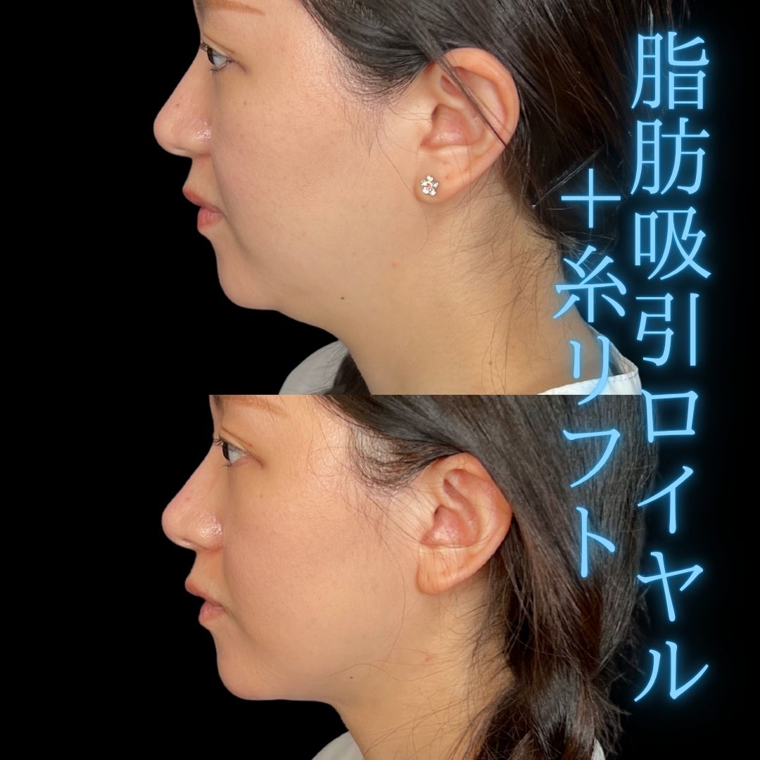 症例写真：小顔脂肪吸引＋糸リフト（術前・術後）