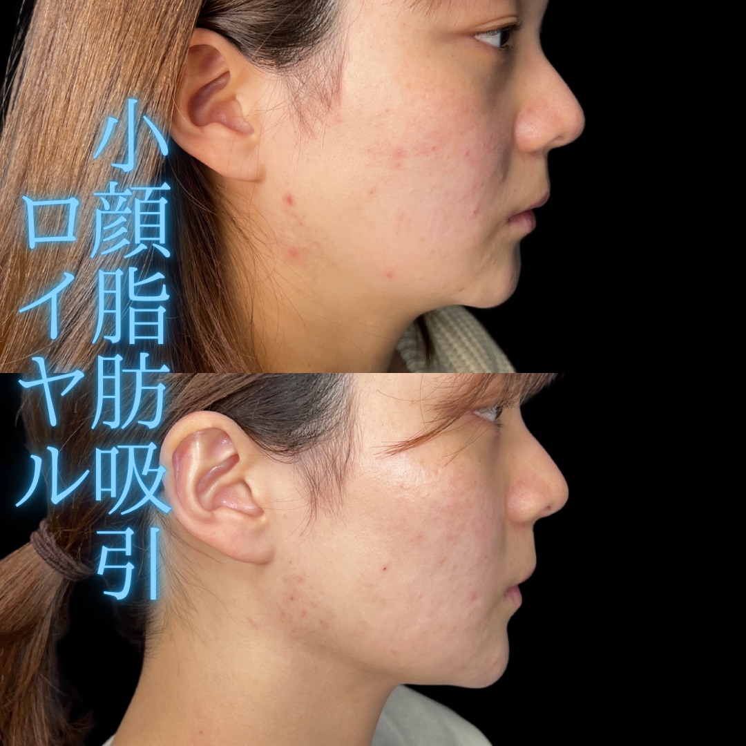 症例写真：小顔脂肪吸引＋糸リフト（術前・術後）