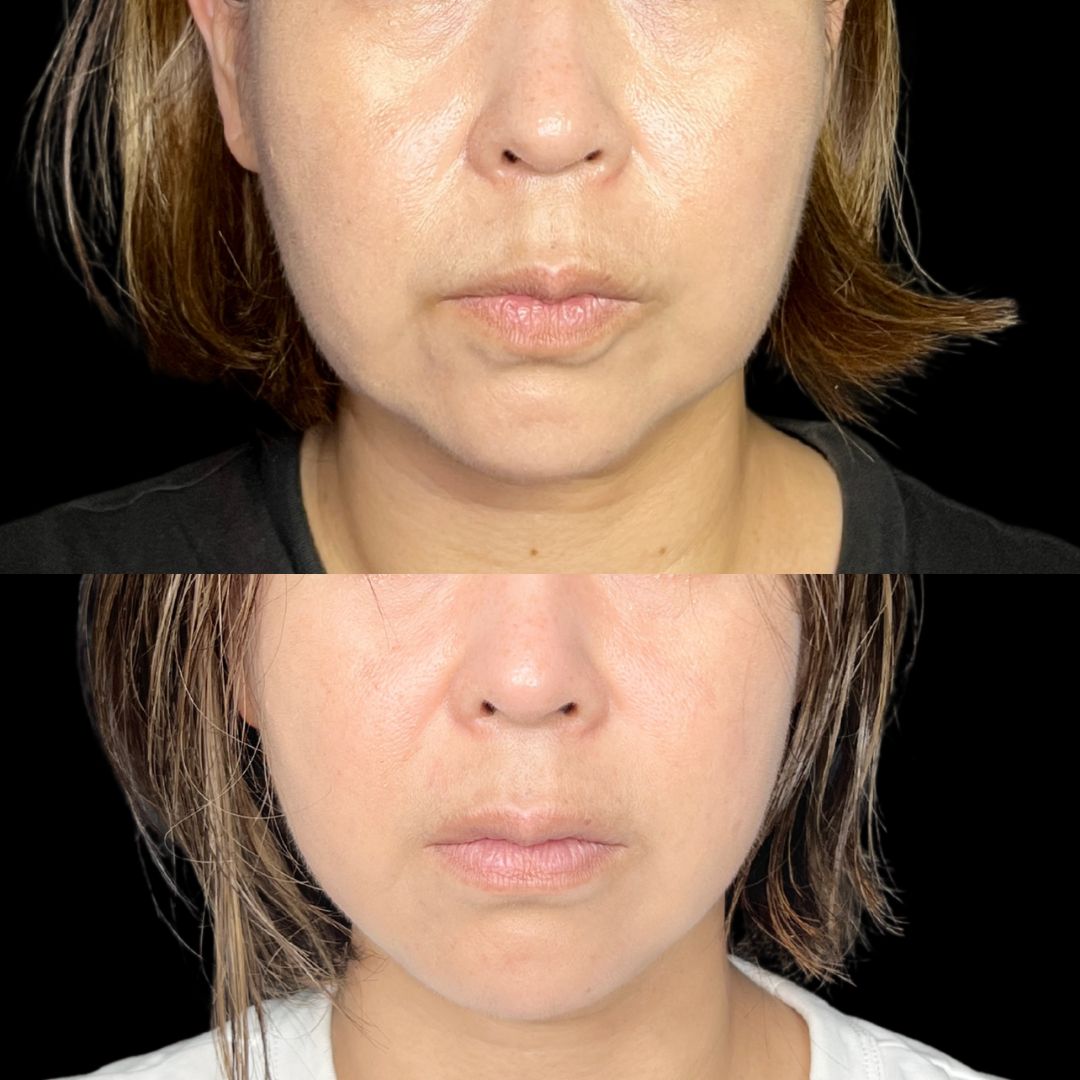 症例写真：小顔脂肪吸引＋糸リフト（術前・術後）