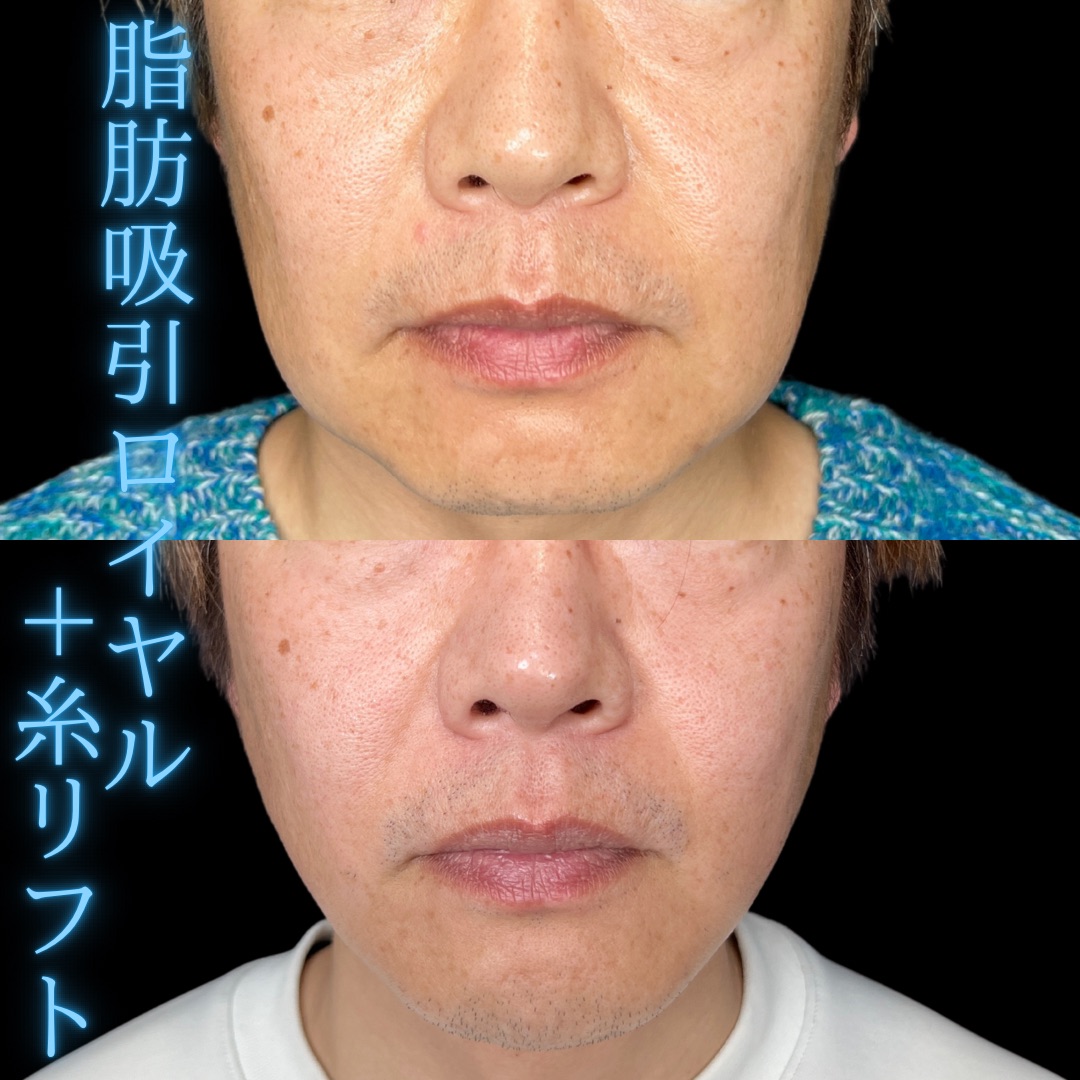 症例写真：小顔脂肪吸引＋糸リフト（術前・術後）