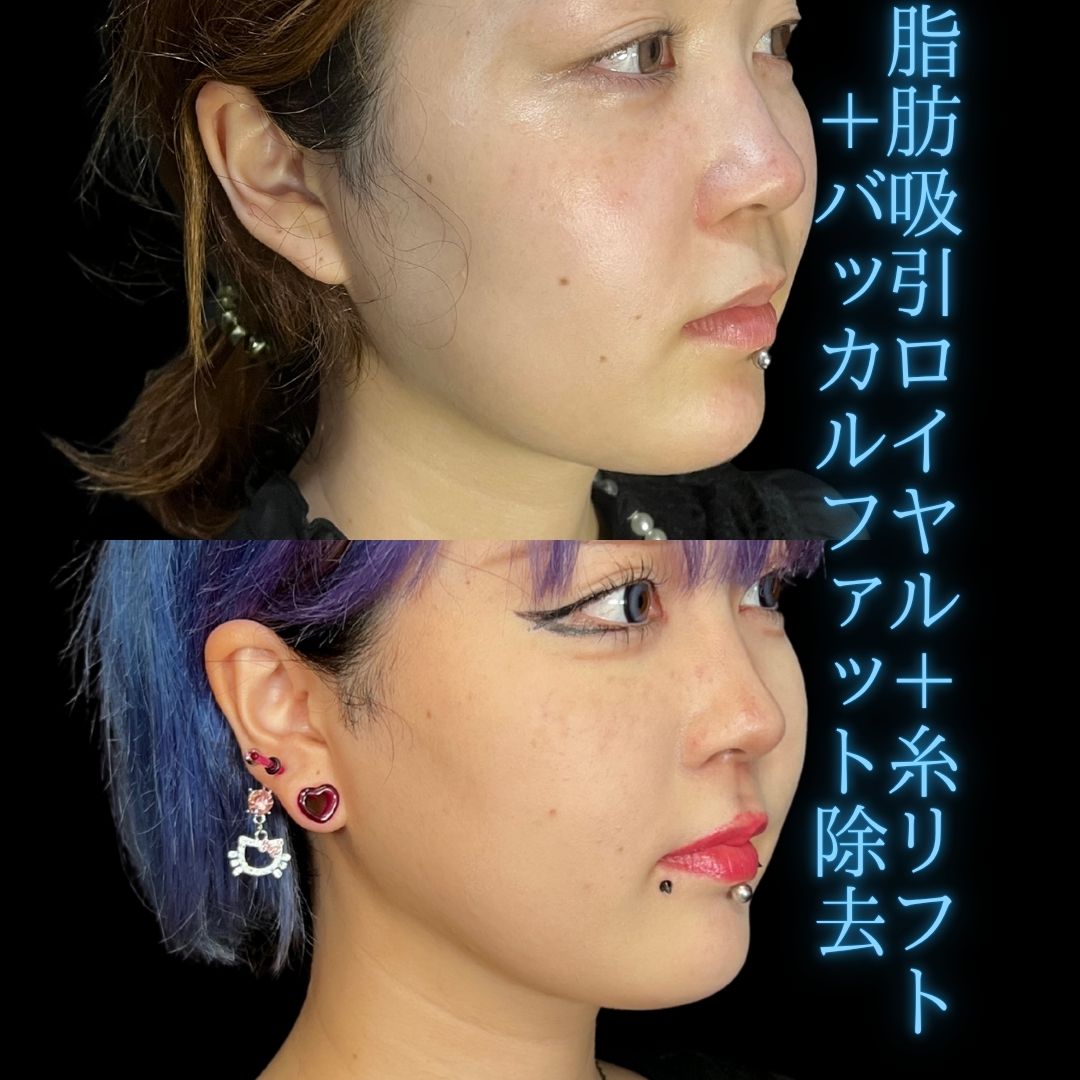 症例写真：小顔脂肪吸引＋糸リフト（術前・術後）