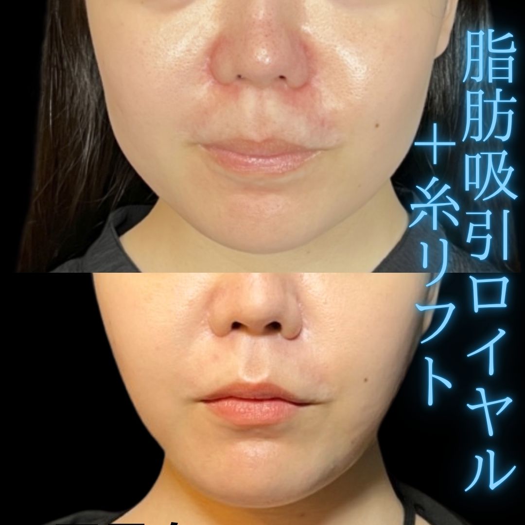 症例写真：小顔脂肪吸引＋糸リフト（術前・術後）