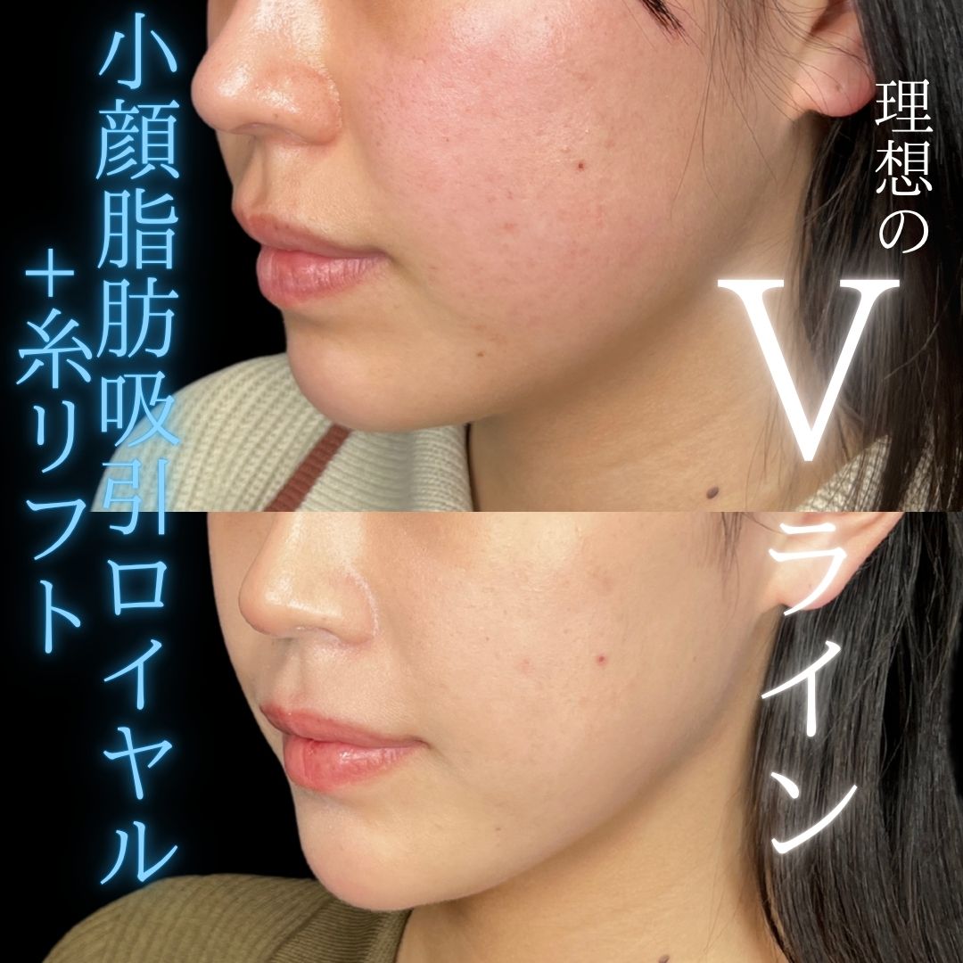 症例写真：小顔脂肪吸引＋糸リフト（術前・術後）