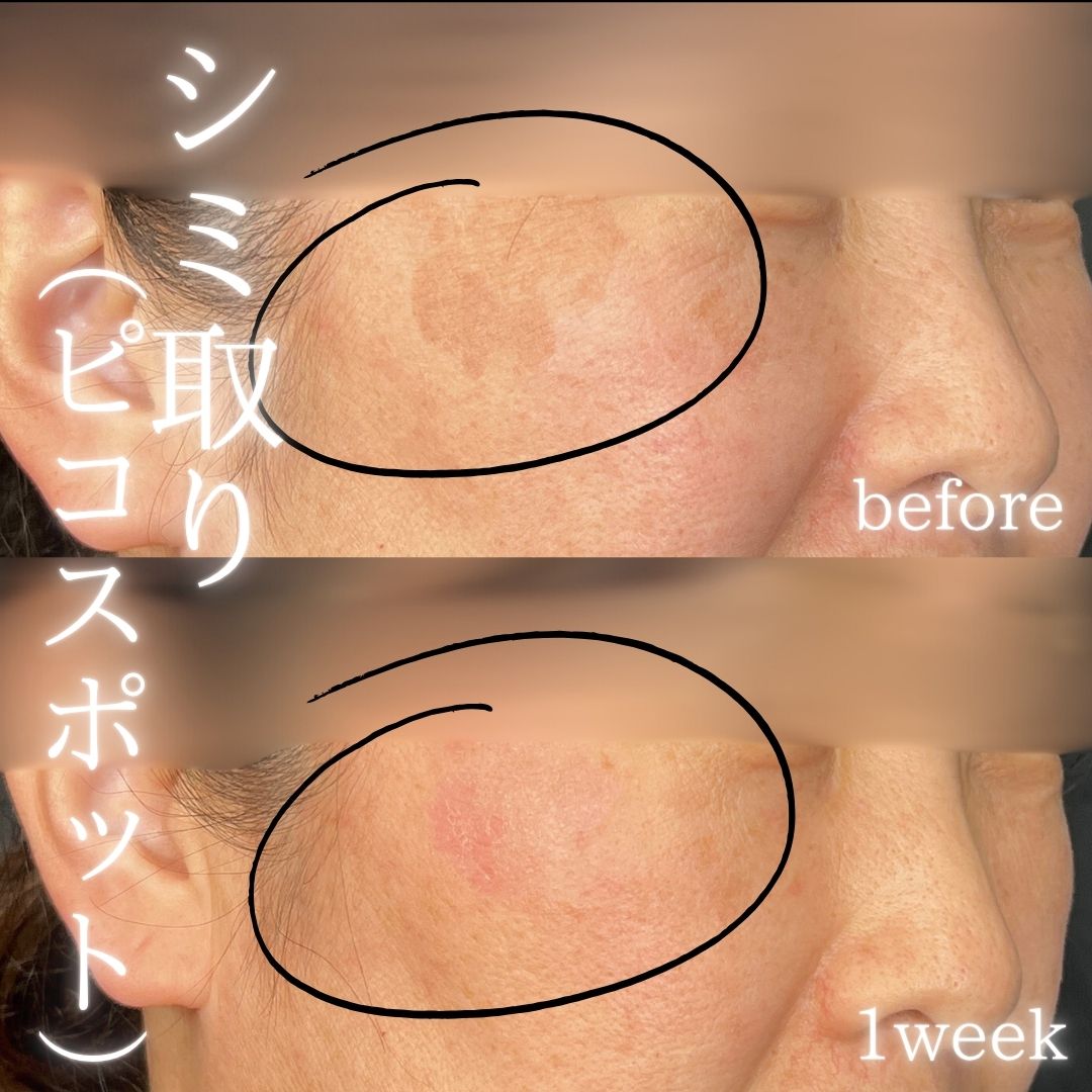 症例写真：シミ取り（ピコスポット）（術前・術後）