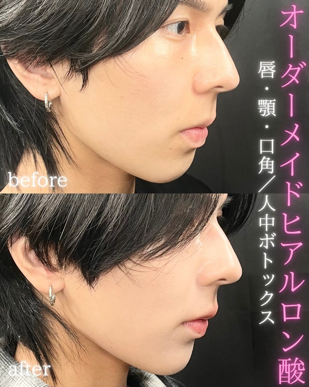 症例写真：オーダーメイドヒアルロン酸（術前・術後）