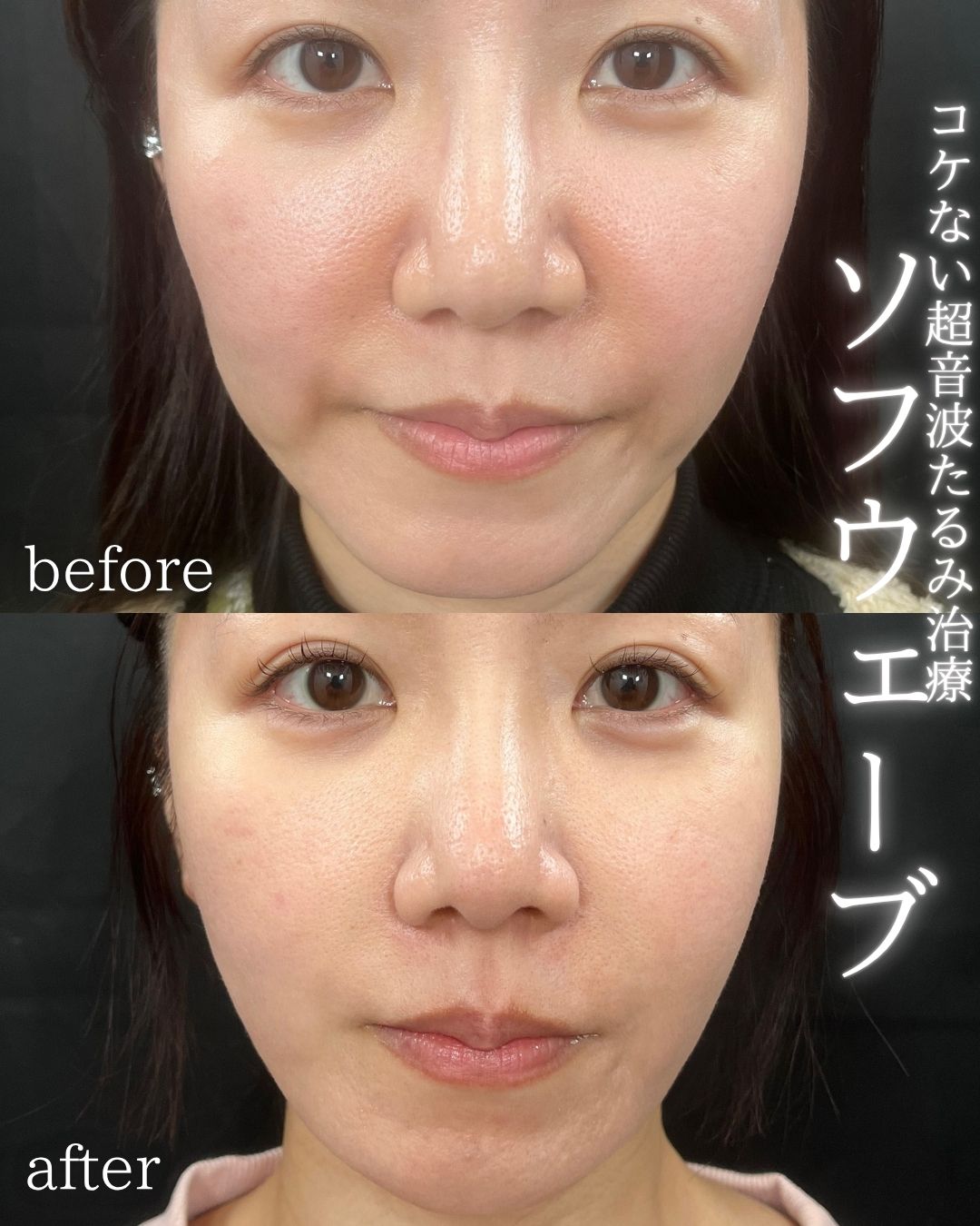 症例写真：ソフウェーブ（術前・術後）