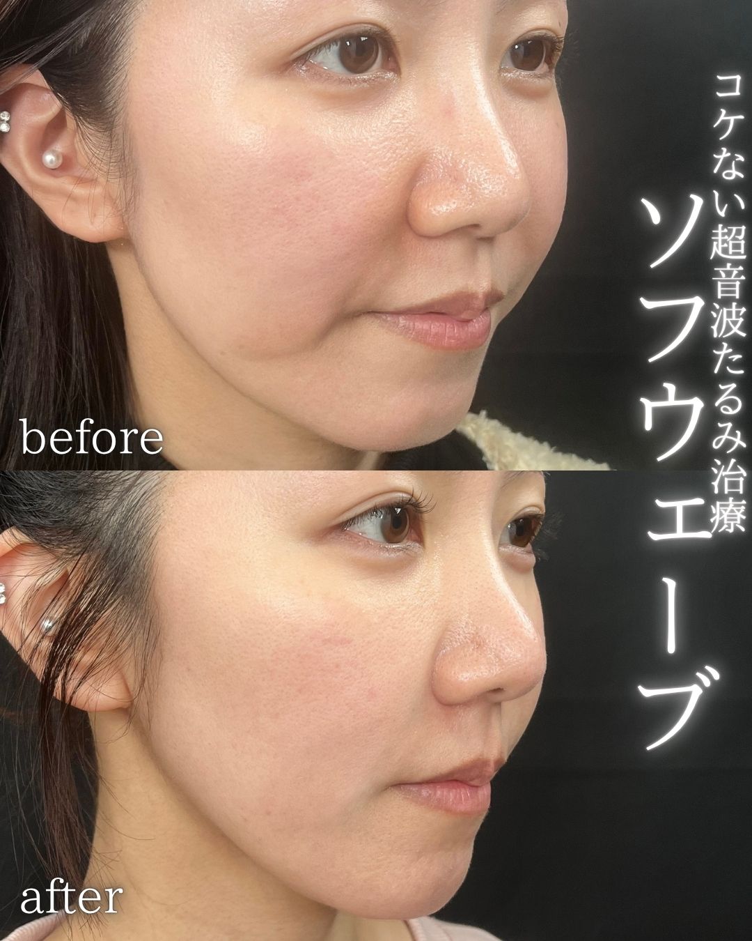 症例写真：ソフウェーブ（術前・術後）