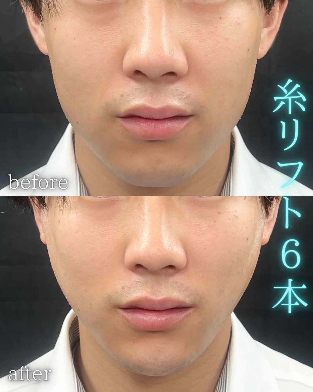 症例写真：糸リフト（術前・術後）