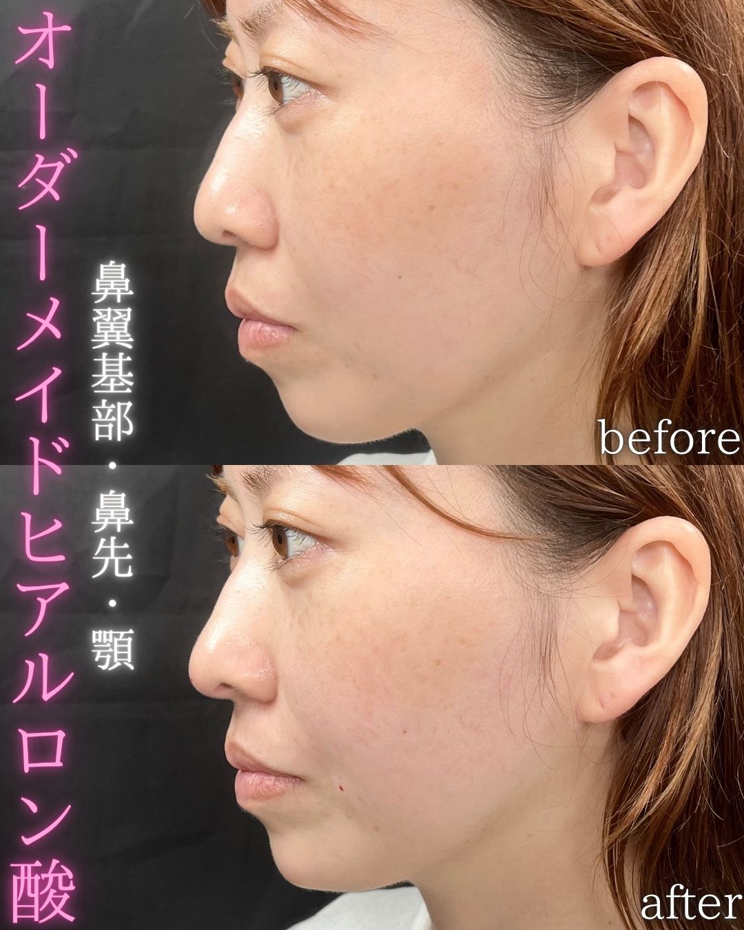 症例写真：オーダーメイドヒアルロン酸（術前・術後）