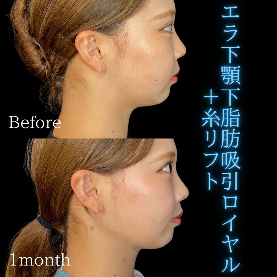 症例写真：小顔脂肪吸引＋糸リフト（術前・術後）