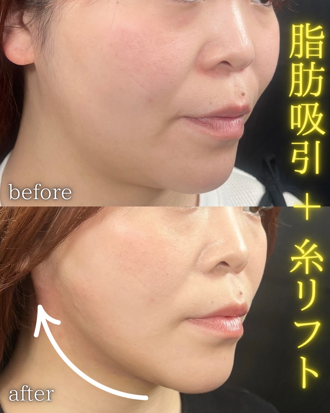 症例写真：小顔脂肪吸引＋糸リフト（術前・術後）