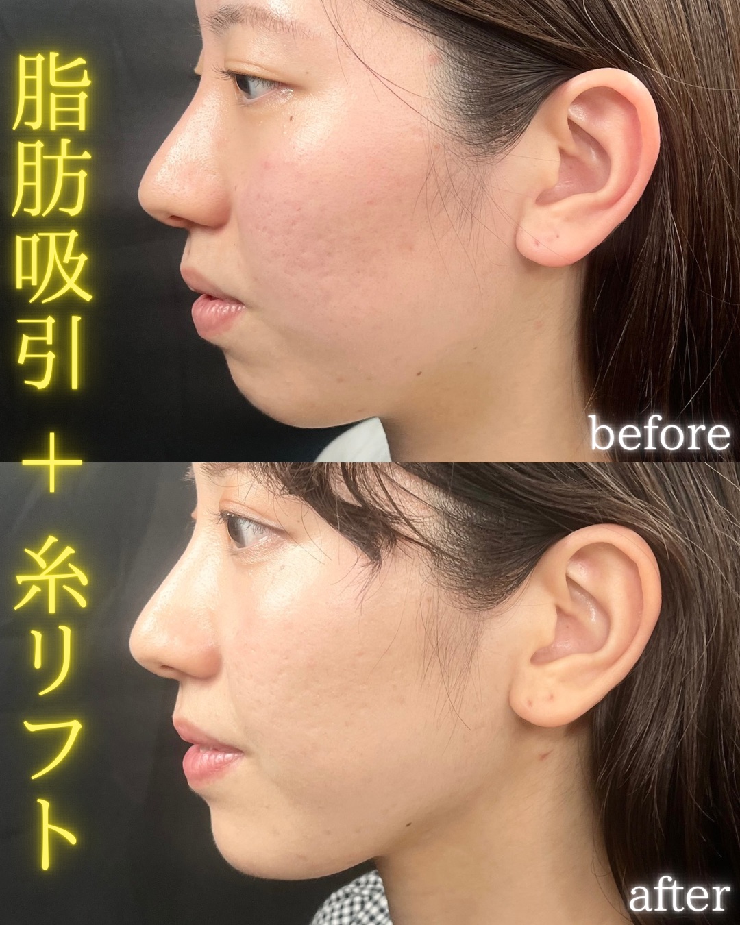 症例写真：小顔脂肪吸引＋糸リフト（術前・術後）