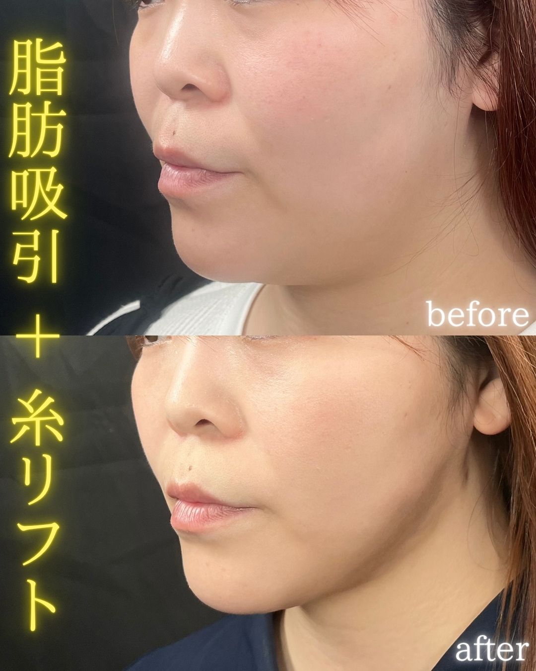 症例写真：小顔脂肪吸引＋糸リフト（術前・術後）