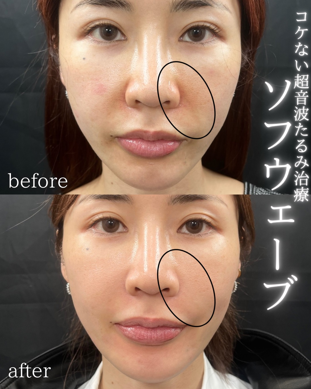 症例写真：ソフウェーブ（術前・術後）