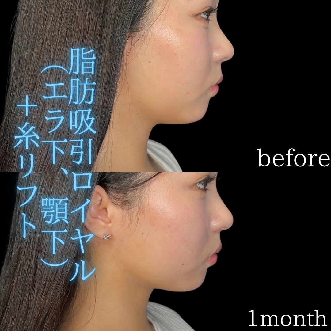 症例写真：小顔脂肪吸引＋糸リフト（術前・術後）