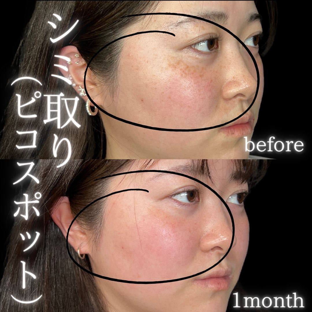 症例写真：シミ取り（ピコスポット）（術前・術後）