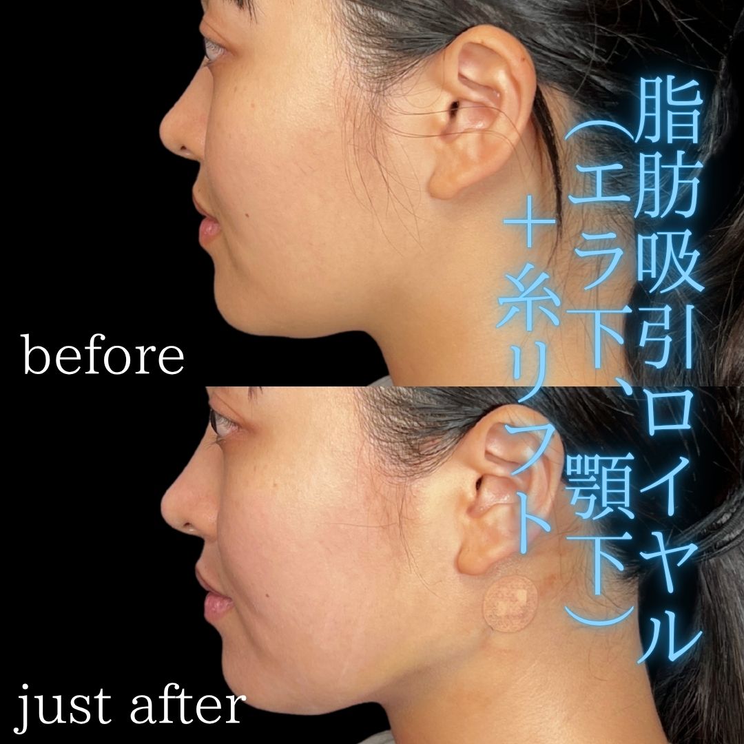 症例写真：小顔脂肪吸引＋糸リフト（術前・術後）
