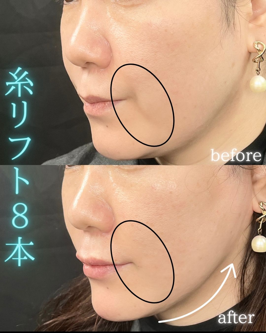 症例写真：糸リフト（術前・術後）