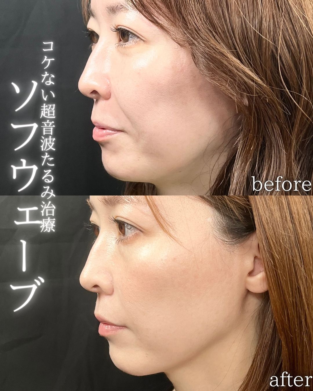 症例写真：ソフウェーブ（術前・術後）