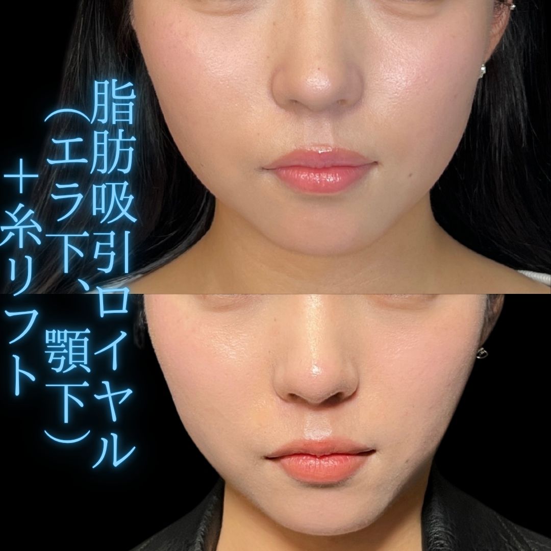 症例写真：小顔脂肪吸引＋糸リフト（術前・術後）