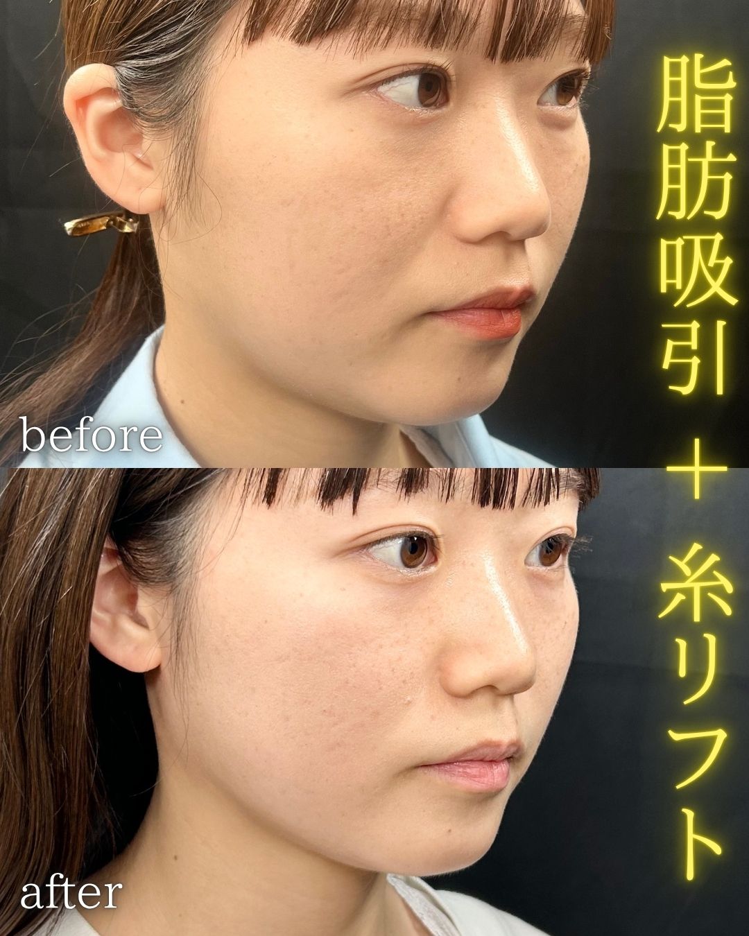 症例写真：小顔脂肪吸引＋糸リフト（術前・術後）