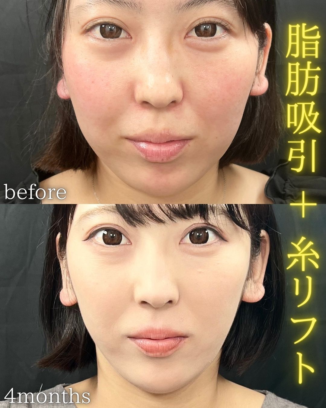 症例写真：小顔脂肪吸引＋糸リフト（術前・術後）
