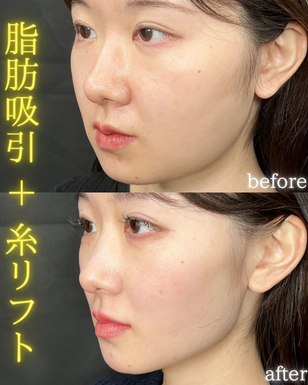 症例写真：小顔脂肪吸引＋糸リフト（術前・術後）