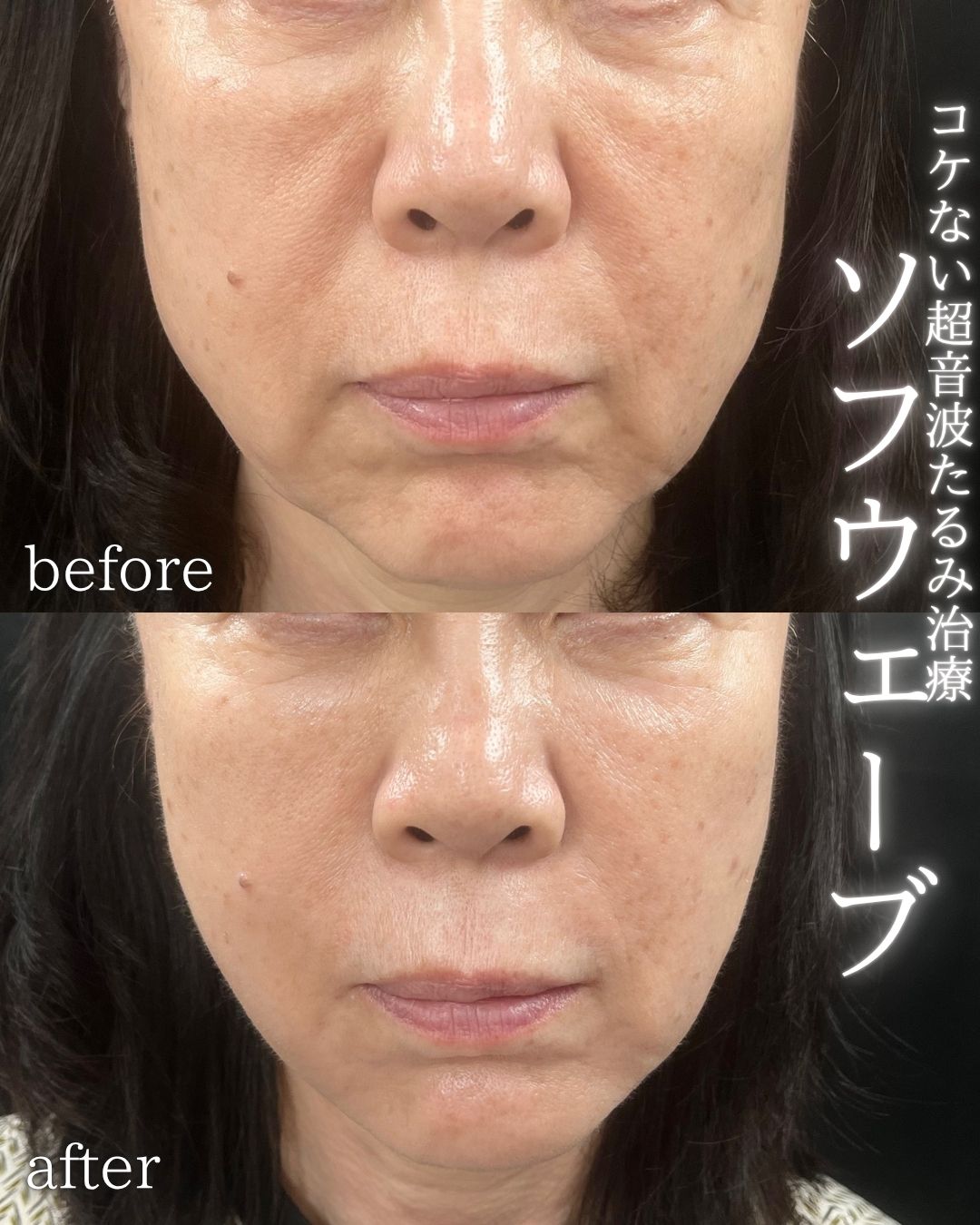 症例写真：ソフウェーブ（術前・術後）