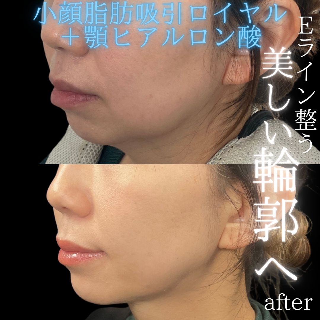 症例写真：小顔脂肪吸引＋糸リフト＋顎ヒアルロン酸（術前・術後）