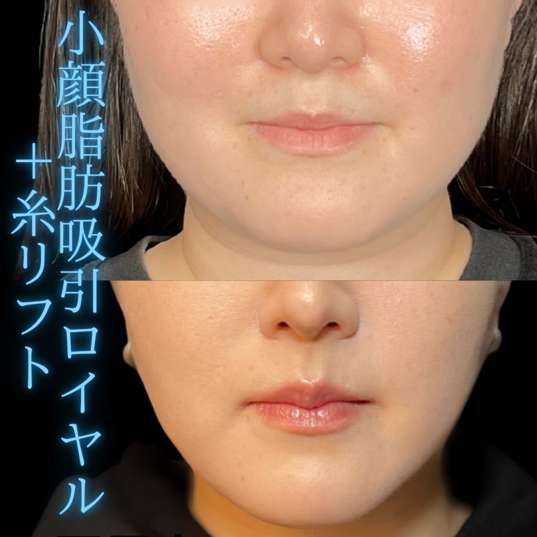 症例写真：小顔脂肪吸引＋糸リフト（術前・術後）