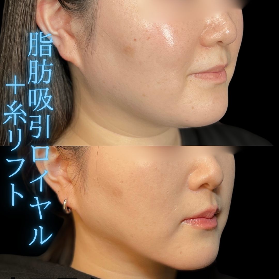 症例写真：小顔脂肪吸引＋糸リフト（術前・術後）