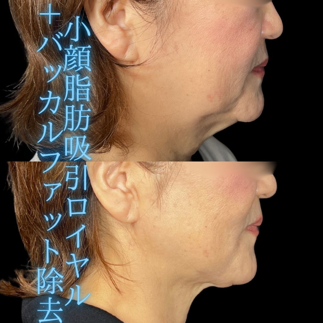 症例写真：小顔脂肪吸引＋糸リフト＋バッカルファット除去（術前・術後）