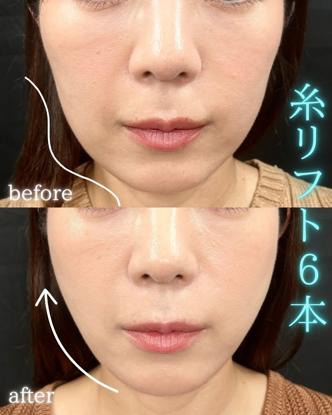 症例写真：糸リフト（術前・術後）