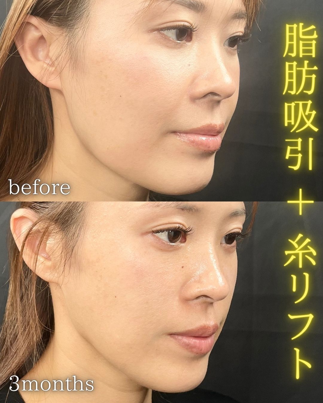 症例写真：小顔脂肪吸引＋糸リフト（術前・術後）