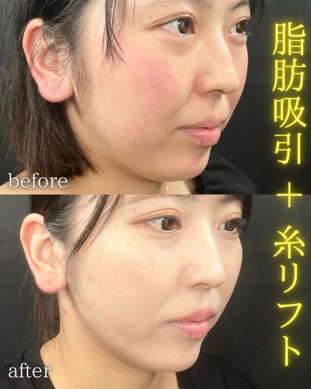症例写真：小顔脂肪吸引＋糸リフト（術前・術後）