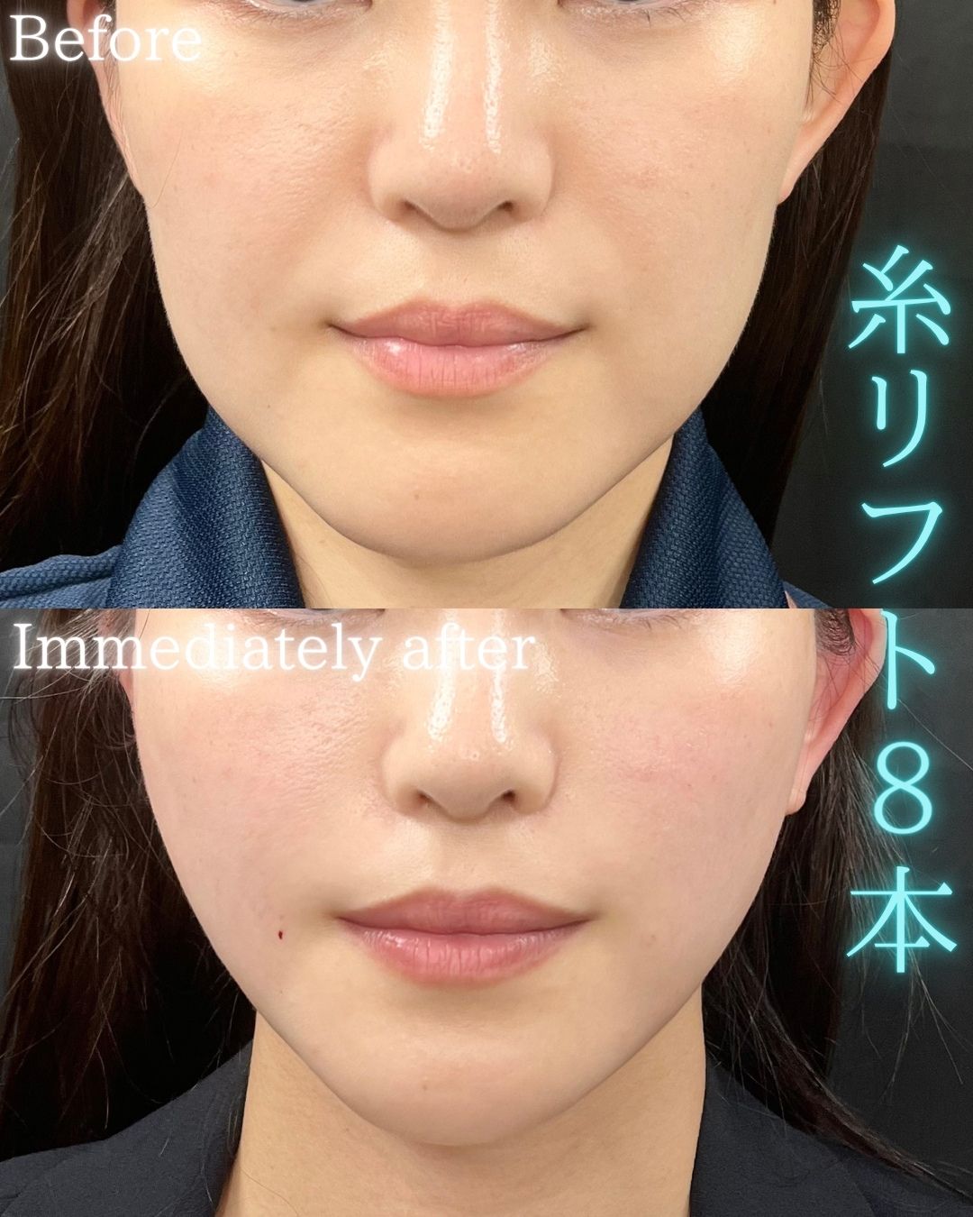 症例写真：糸リフト（術前・術後）