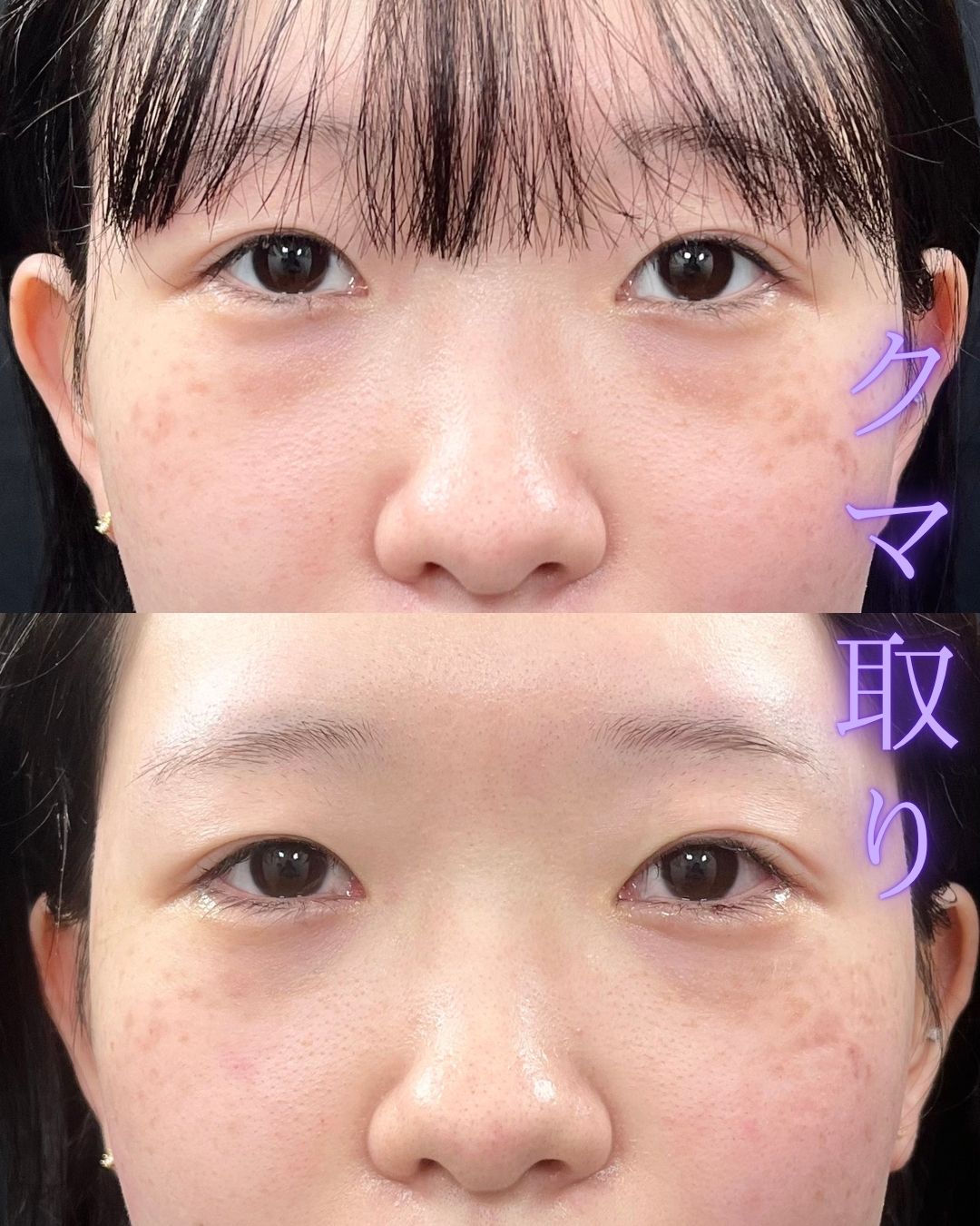 症例写真：クマ取り（術前・術後）